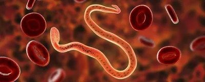 Premier India | लिम्फेडेमा रोगियों की पहचान और ग्रेडिंग को लेकर आयोजित...